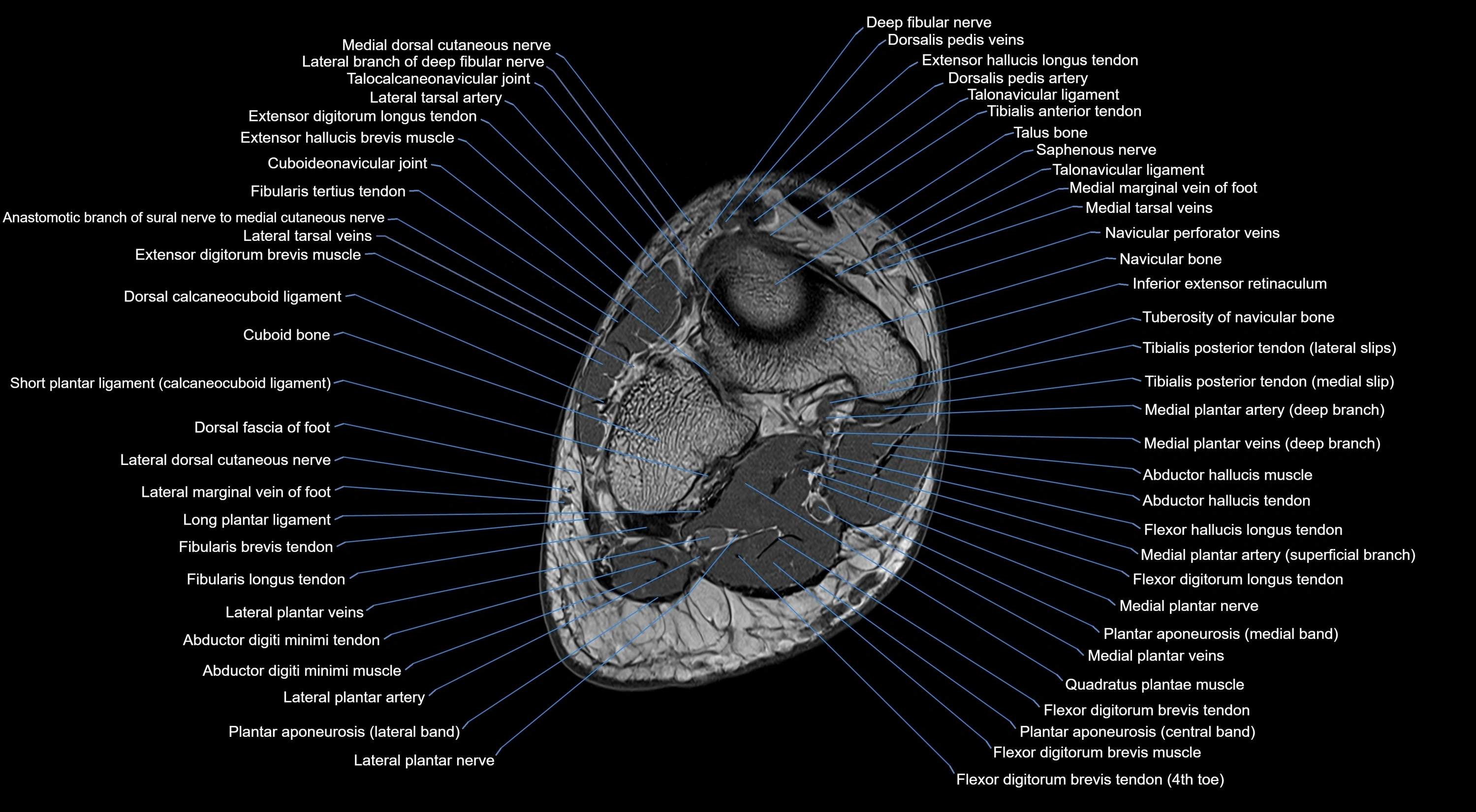 MRI mid foot coronal ligaments cross sectional anatomy 3T  radiology  image-img-00001-00032.webp
